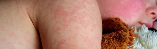 WHO ja CDC hoiatavad sagenevate leetritest tingitud surmade eest