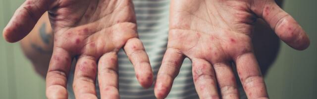 WHO hoiatab: leetritest on saanud taas otsene ülemaailmne oht