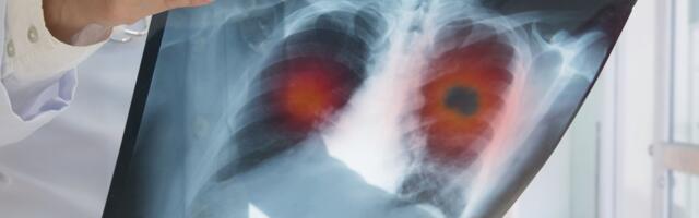 Hiiliv kopsuvähk: veriköha ei ole sümptom, mida kodus ise ravida