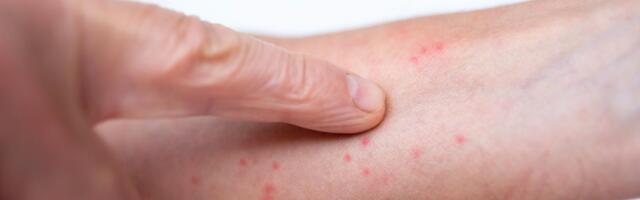 Hea teada: mis on sügelised ja kuidas nad levivad?