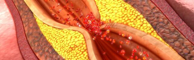 Soome kardioloog: pärgarteritõbi on nii levinud, et seda pole mõtet sõeluurida