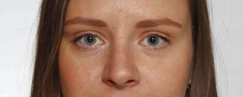 Kuiva silma sündroomi süsteemsed põhjused