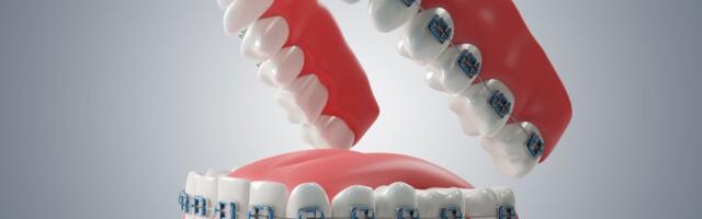Hambaarstid tahaksid teha ortodontilist ravi, aga ortodondid ei ole nõus