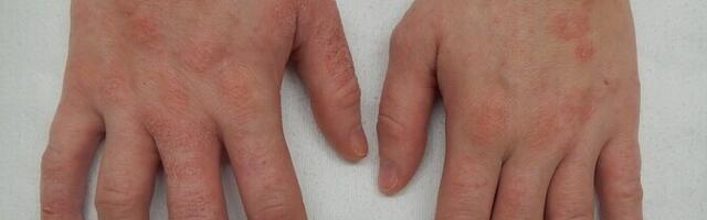 Sügelevat ekseemi põhjustavad kindlad närvirakud