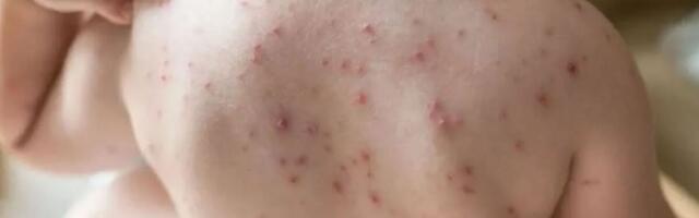 Indias on COVIDi juhtude kasvuga laste seas levima hakanud nn tomatigripp