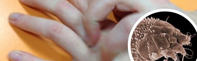 Tallinna koolis on probleeme sügelistega. Lapsevanema hinnangul on juhtumeid rohkem kui kool tunnistab