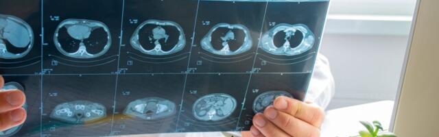 Kuidas ära tunda interstitsiaalset kopsuhaigust?