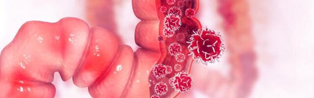 USA uroloogi arvates võiks noortele teha rohkem kolonoskoopiat