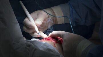 Operatsioonitoa kirurgilisest suitsust kui terviseriskist