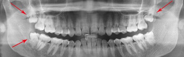 Tarkusehammastest – kas nende eemaldamine on vajalik ja mõttekas?
