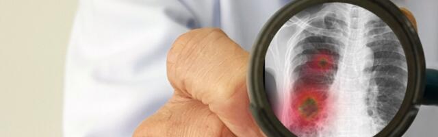 Soomes on kasvanud haiglaravi vajavate bakteriaalsete põletikega patsientide arv