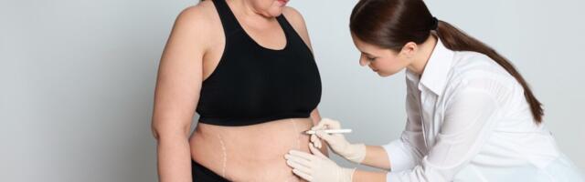 Uuring: Bariaatriline kirurgia on tõhus vererõhu alandaja