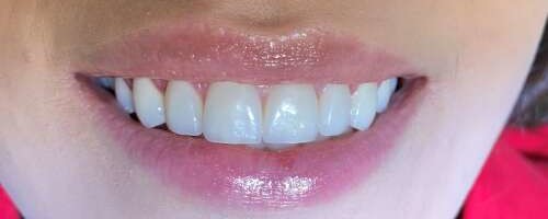 Mis juhtub tervisega, kui suuhügieen pole piisav?