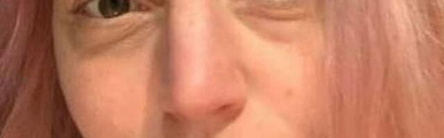 Covid-19 vaktsiinist tekkinud reaktsioon muutis naise välimuse tundmatuseni