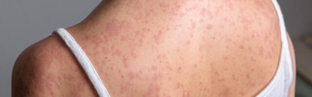 Tallinna kooliõed: mullu jäi meil leetrite vastu süstimata enam kui kahe hiigelsuure kooli jagu õpilasi