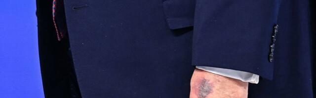 Trump selgitas vasakul käel laiutavat verevalumit_ lõin end vastu lauda ära