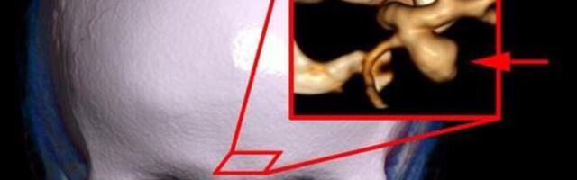 Uuring: suitsetavatel naistel on palju ajuarteri aneurüsme