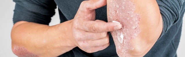 Bioloogiline ravi tõstab naharavi uuele tasemel