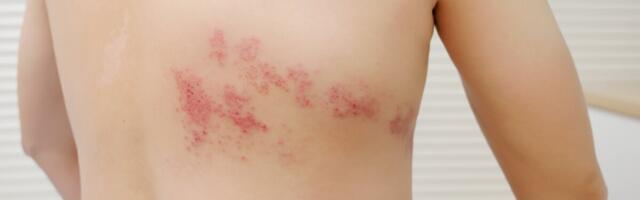 Vöötohatise vastane vaktsiin näib vähendavat dementsuse riski