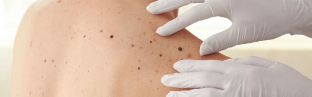Melanoom võib tekkida ka ilma eelneva päikesepõletuseta
