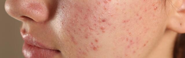 Akne on jälle tagasi? Spetsialist: mida kiiremini abi otsitakse, seda parem