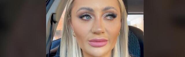 Aastaid huuli suurendanud naine eemaldas täiteaine - tulemus on jahmatav!