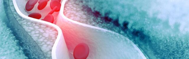 Kõrgeim kolesteroolinäit naisel oli 29.5 mmol/l