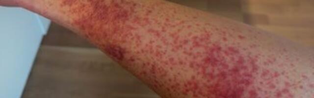 Temust tellitud koorimiskinnas viis 23-aastase naisterahva  haiglasse: „Kartsin, et mu jalg tuleb amputeerida“