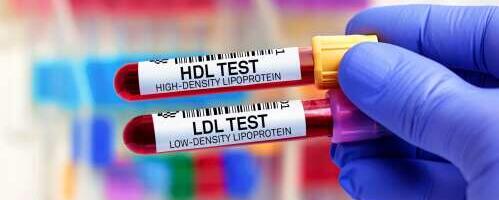 Kõrge LDL-kolesterooli taseme esimene “sümptom” on tihti infarkt või insult