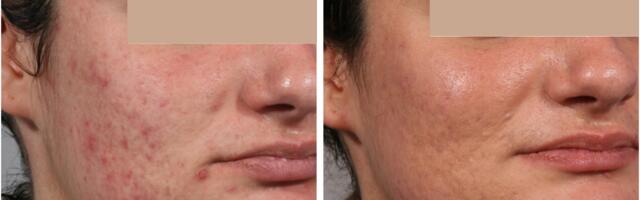 Uudis! RF koos Microneedlinguga: sügav naha 3D modelleerimine ja noorendamine Iisraeli teadlastelt