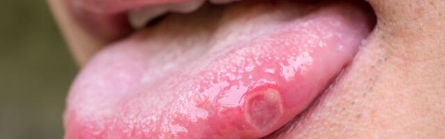 Kuidas annab märku keelevähk ja keda see ohustab?