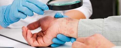 Psoriaas: õige nahahoolduse ja raviga saab lööbeta naha