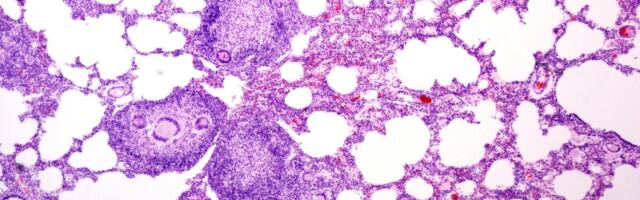 Tuberkuloosi olukord vajab jätkuvalt tähelepanu