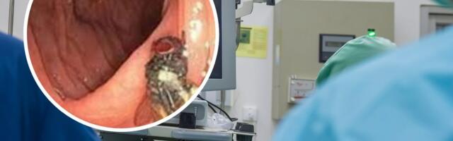 Jäletu leid mehe soolestikust: käärsooles asetses terve kärbes