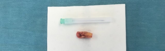 Foto ja selgitus: selline ongi tromboos