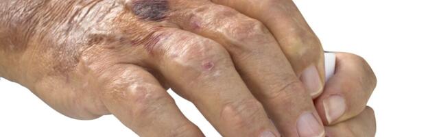 Reumatoidartriidi ravimiga koroonaviiruse vastu