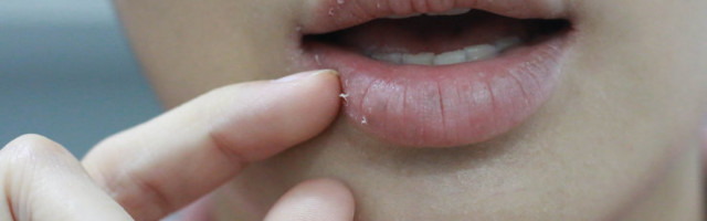 Kui sinu huuled on sügisel kuivad ja lõhenenud, tasuks võtta kuulda dermatoloogi soovitusi