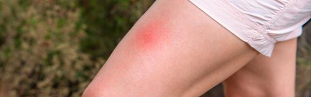 Soomes testitakse uut borrelioosivaktsiini