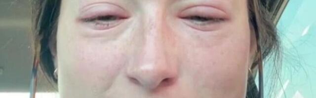 USA naisel tekkis ripsmepikenduste paneku järel ränk allergiline reaktsioon