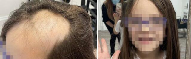 Laps kaotas kooki tehes õnnetuse läbi suure osa oma juustest