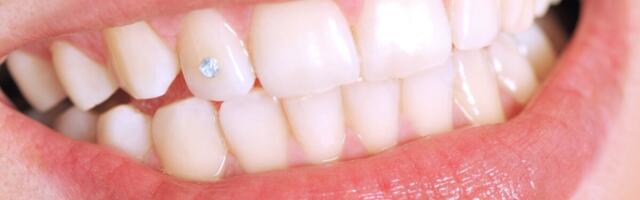 Terviseamet: millele pöörata tähelepanu hambakaunistuste paigaldamisel?