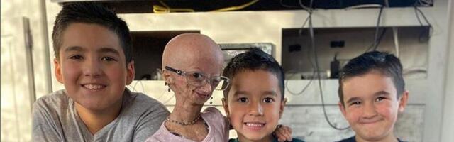 Haruldase haigusega võidelnud Youtube'i staar Adalia Rose suri 15-aastasena