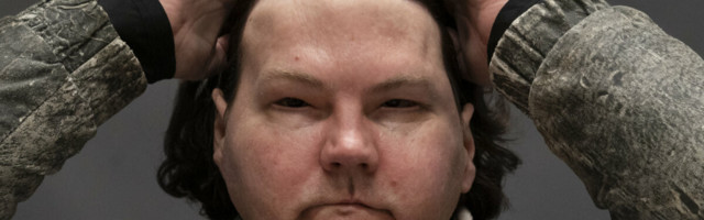 VIDEO JA FOTOD | Uskumatu siirdamine: mees sai uue näo ja käed ning elab edasi