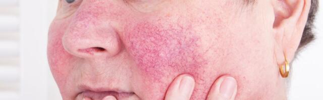 Kuidas vabaneda liigsest punetusest näos?