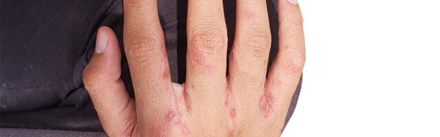 SA Tallinna Koolitervishoid on Tallinna koolides näinud üksikuid sügeliste juhte