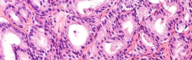 Georgi Džaparidze kaitses doktoritöö eesnäärme adenokartsinoomist