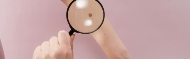 Melanoomi avastatakse Eestis järjest rohkem