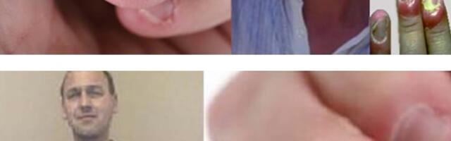 Küünte närimine võib tuua kaasa surma