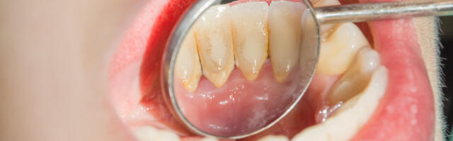 LOE, kuidas eemaldada hambakattu ja hambakivi ilma hambaarsti juurde minemata