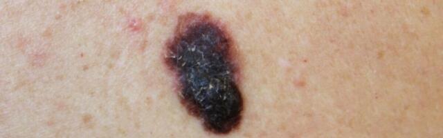 Uuring: igal neljandal eakal leiti nahavähk või selle eelne seisund